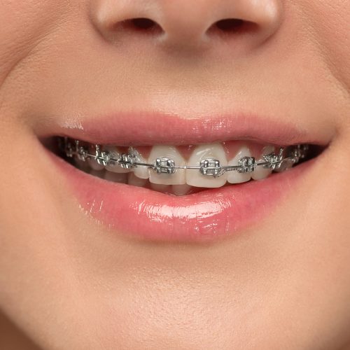 Braces Straighten Teeth and Correct Improper Bites