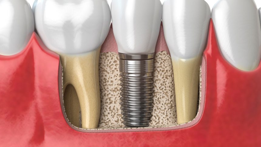 Dental Implants are a permanent solution to missing teeth