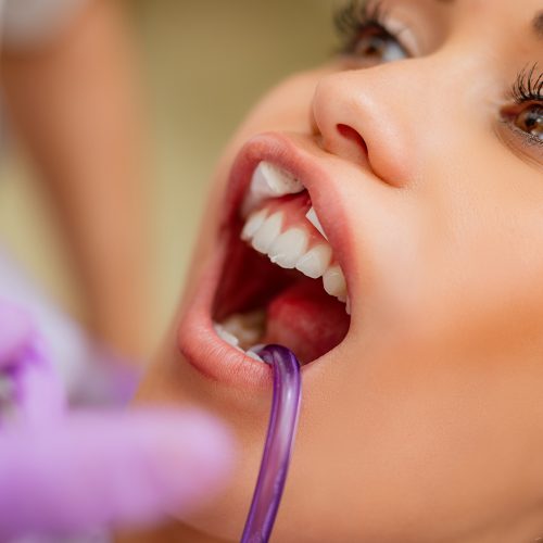 Teeth Whitening for a brighter smile at Coney Island Dental